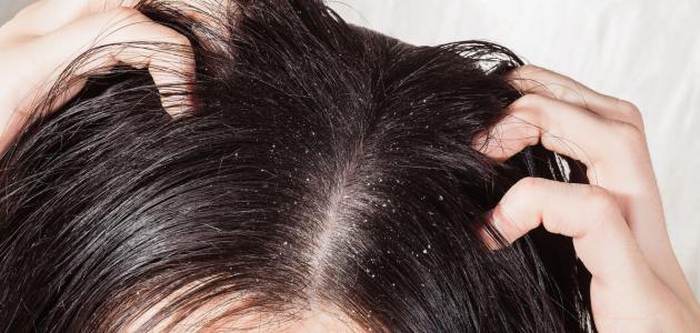 أفضل الطرق لإزالة القشرة من الشعر